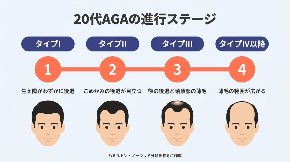 AGAの進行ステージをタイムラインで示した図。タイプⅠからタイプⅣ以降まで4段階で解説(AGAの20代初期症状)