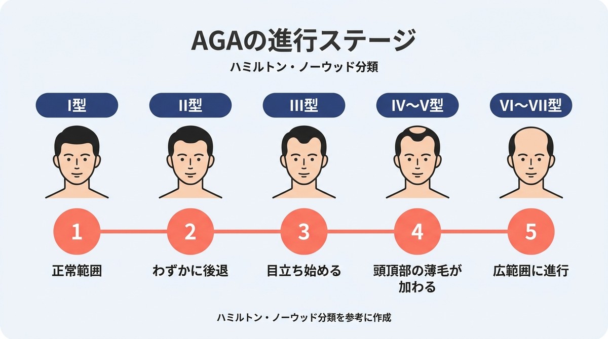 生え際の後退|ハミルトン・ノーウッド分類でAGAの進行ステージをI型からVII型まで示したタイムライン図(AGA 生え際)